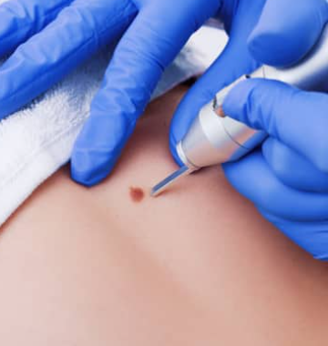 Does a Skin Tag Remover Pen Hurt or Work Well？